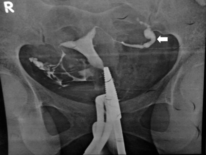 Hysterosalpingography showing left hydrosalpinx with fimbrial block (arrow).